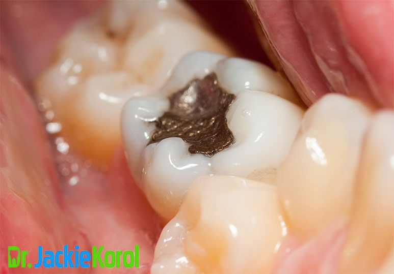 Mercury Fillings: Effects and Safe Removal Practices
