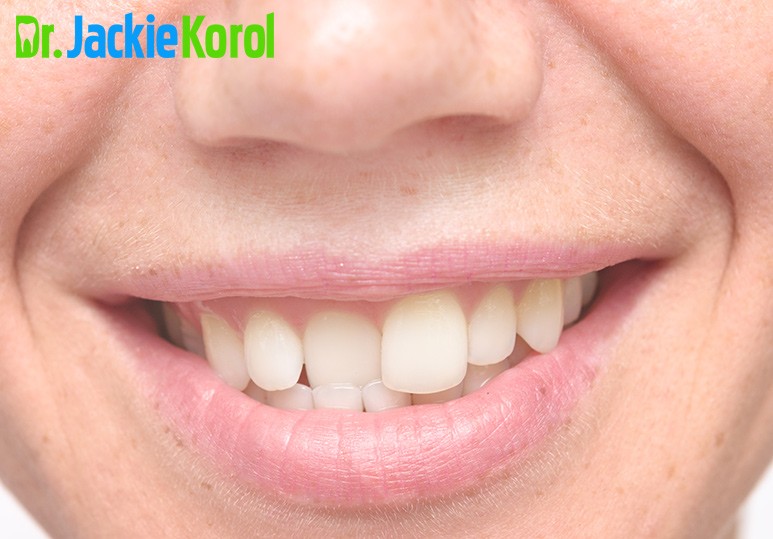 Are Crooked Teeth or Misaligned Teeth Bad for your Health ...