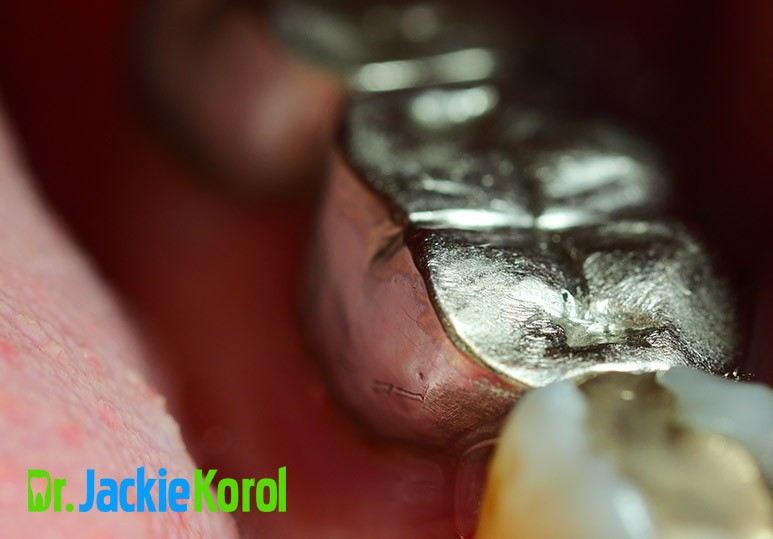  4 Key Facts About Amalgam Filling Removal 