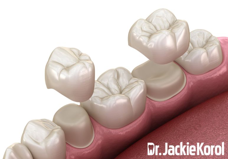 Calgary Dental Crowns: Composite vs. Porcelain Crowns