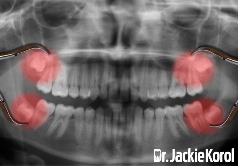 Wisdom Tooth Extraction: Signs You Need It and What to Consider