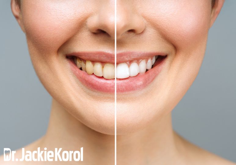 Teeth Whitening Results: What to Expect Before and After Treatment