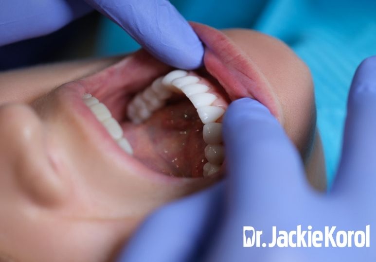 How Veneers Are Applied: A Step-by-Step Guide
